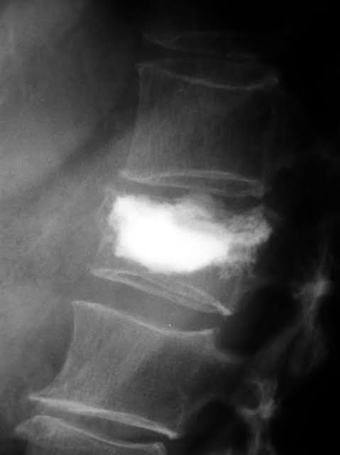 WHAT-IS-KYPHOPLASTY-AND-HOW-IT-IS-USED-TO-TREAT-SPINAL-FRACTURES